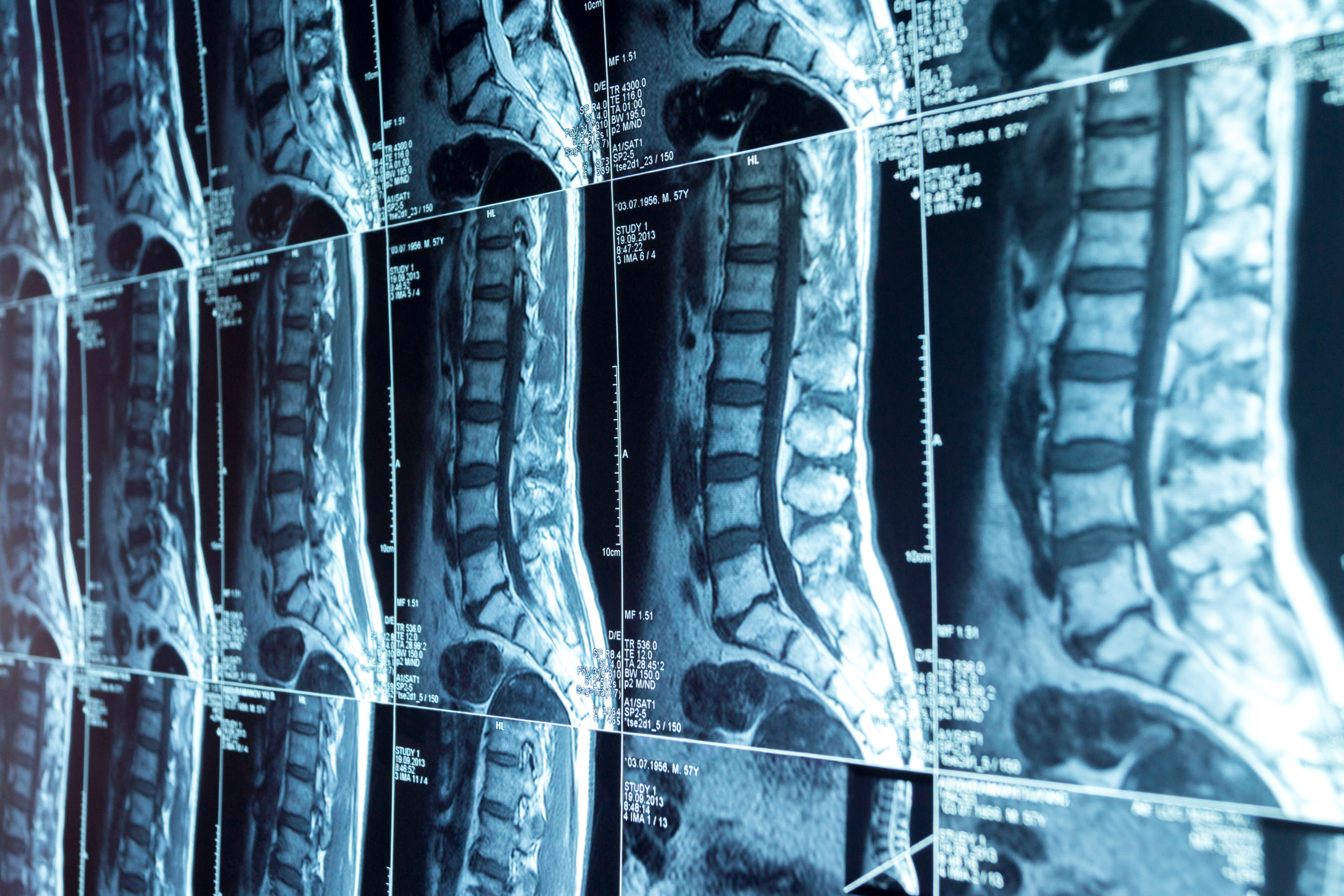 MRI scans of the lumbosacral spine